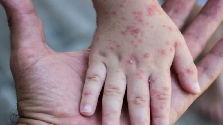 الصحة المصرية: نسبة احتمال تفشي جدري القرود في مصر منخفضة للغاية