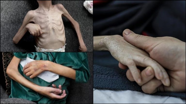 وزارة الصحة بغزة تعلن عن وفاة 60 طفلاً بسبب سوء التغذية جراء الحصار الإسرائيلي
