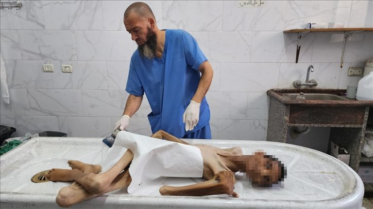 عادل ماضي.. شاب فلسطيني يتحول إلى “هيكل عظمي” قبل أن تفتك به المجاعة في غزة