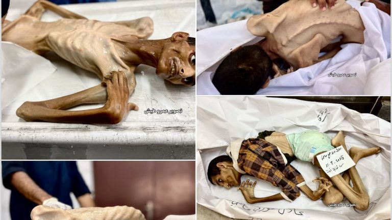 وفاة شاب في غزة بسبب الجوع وسوء التغذية في مجمع ناصر الطبي