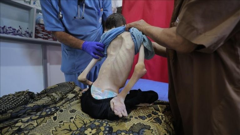ارتفاع عدد ضحايا المجاعة في غزة إلى 162 بينهم 92 طفلًا