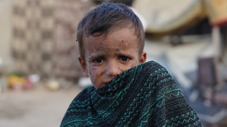 أكثر من 125 ألف إصابة جلدية في غزة خلال 5 أشهر وسط تفشي القوارض والطفيليات